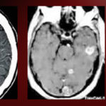 Evidence based Guidelines for Stereotactic