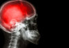 Point: Chronic Traumatic Encephalopathy: A Real Disease, but Not a New One