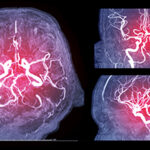Collection of Magnetic resonance image (MRI) of Vessel in the br