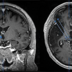 Figure 1 – DBS Planning