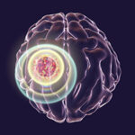 Destruction of brain tumor