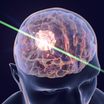 radiosurgery_feature