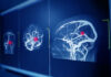 Advocates for Brain Aneurysm Research